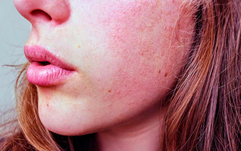 dry-skin. jpg